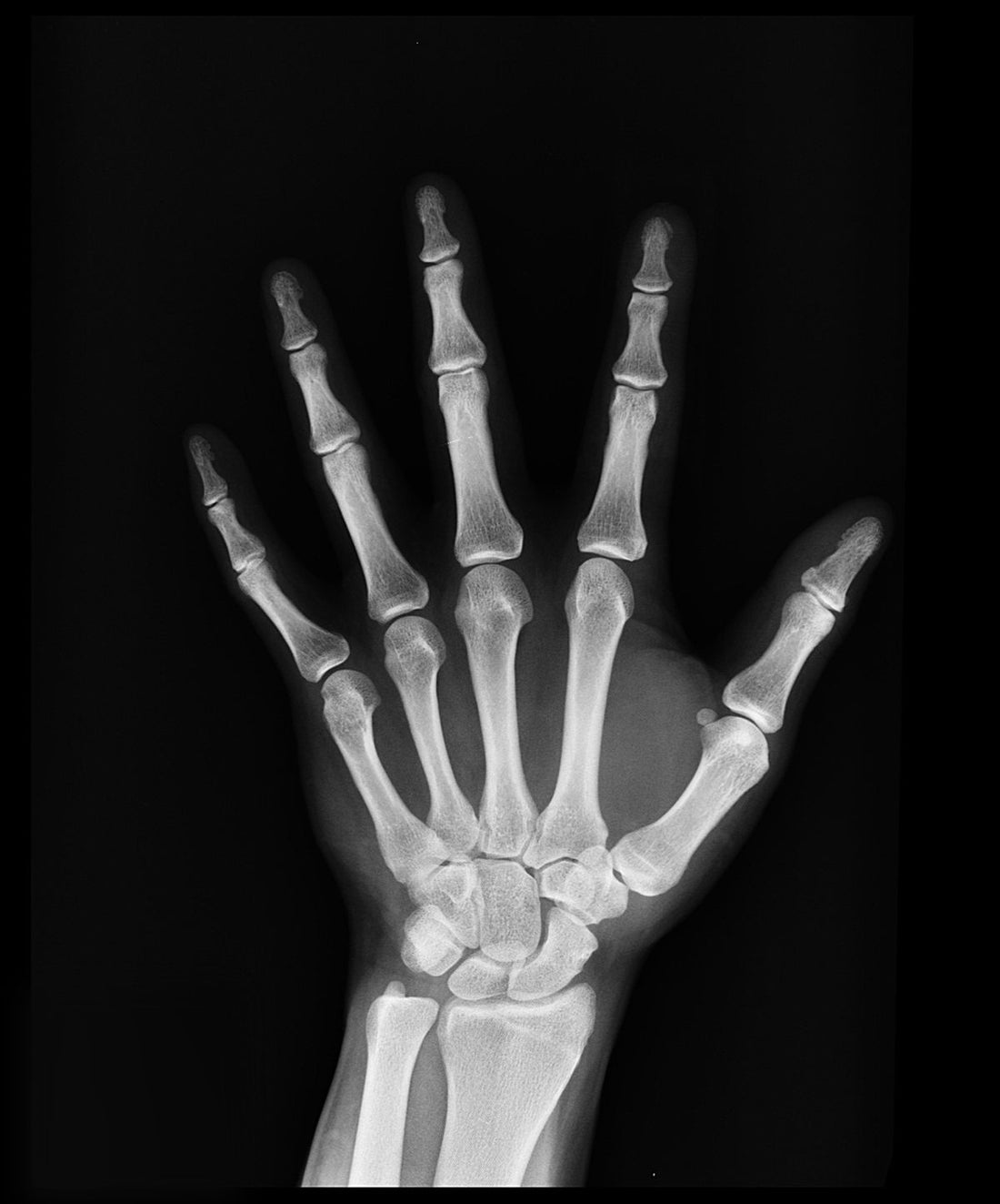 Dark x-ray of a human hand showing the bones against a black background